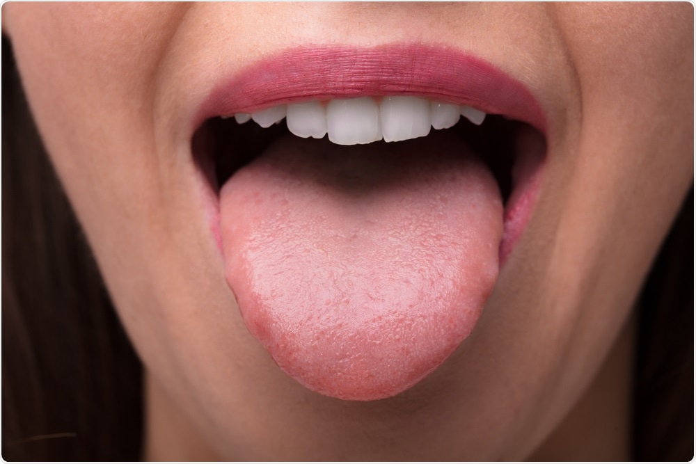dysbiosis white tongue)