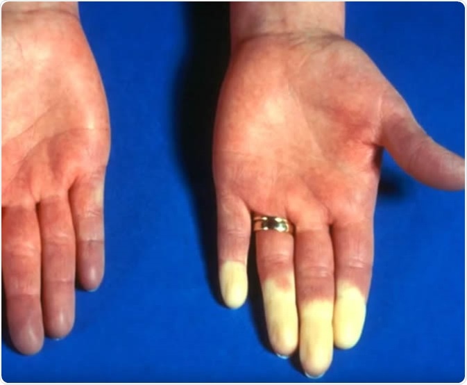 Raynaud S Syndrome Signs And Symptoms