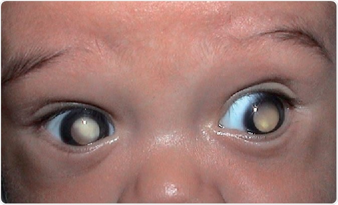 Eye disease in infants detected using smartphone app