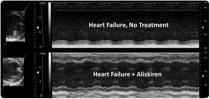 The treated image shows improved contractility of the heart, less ventricle/chamber dilation and improvement in wall thickness compared to the untreated heart