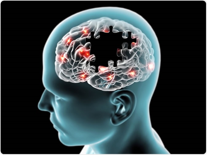 Alzheimer&#39;s Disease | Definition, Causes, Diagnosis &amp; Treatment