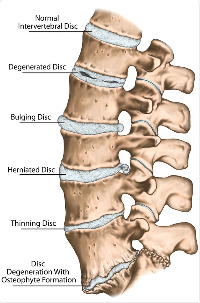 Herniated Disc Treatment