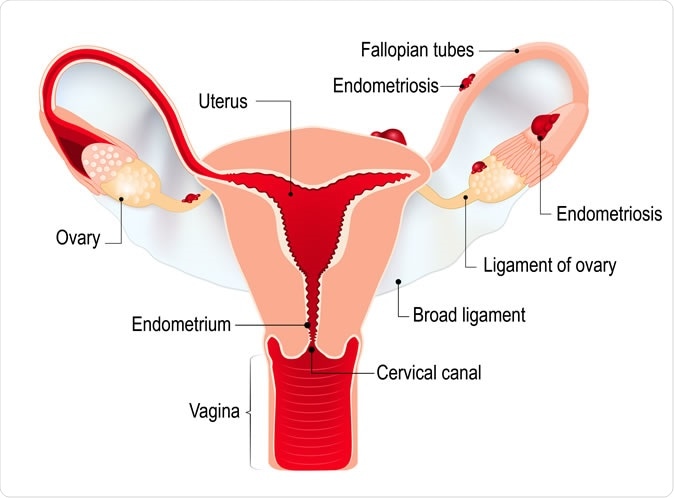 Endometriosis: Thousands of women suffer from debilitating pain