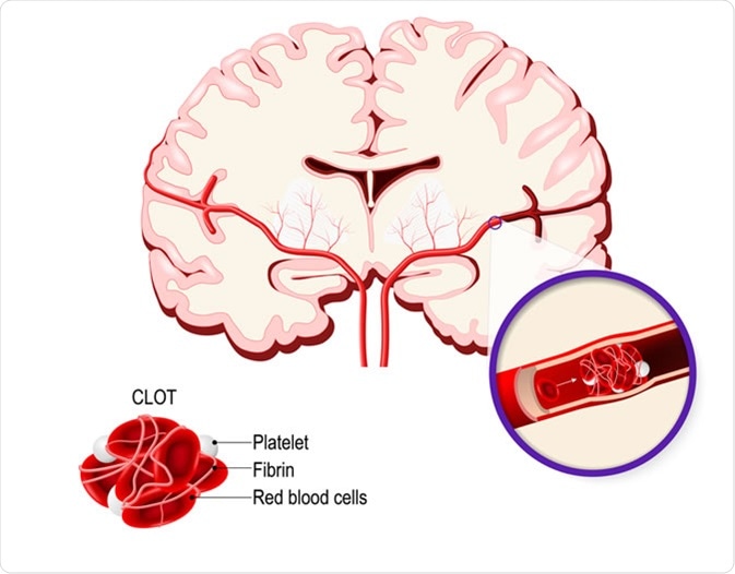 Do Migraines Increase Risk of Stroke?