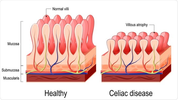 Celiac disease may now be curable with biodegradable nanoparticles