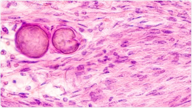 New insight into meningioma - possibility of targeted therapy