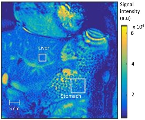 Researchers develop revolutionary method using MRI to diagnose digestive disorder