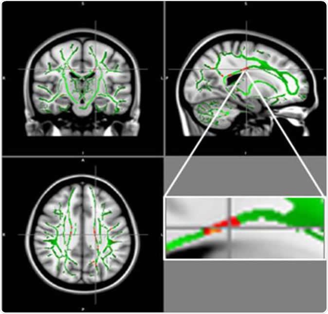 Obese teenagers at risk for brain damage, suggests new study