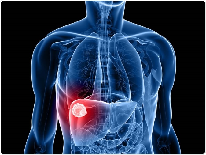 Deaths from liver cancer increased 3-fold over 20 years in England