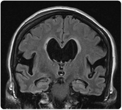 Study: Many patients treated for iNPH also develop Alzheimer’s disease