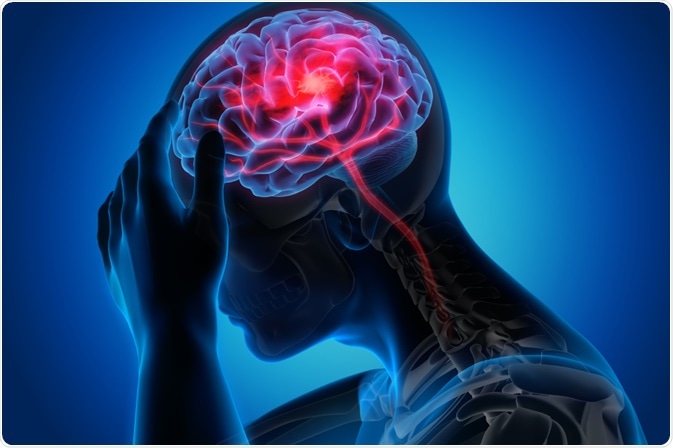 Dores de cabeça freqüentes após uma lesão cerebral traumático