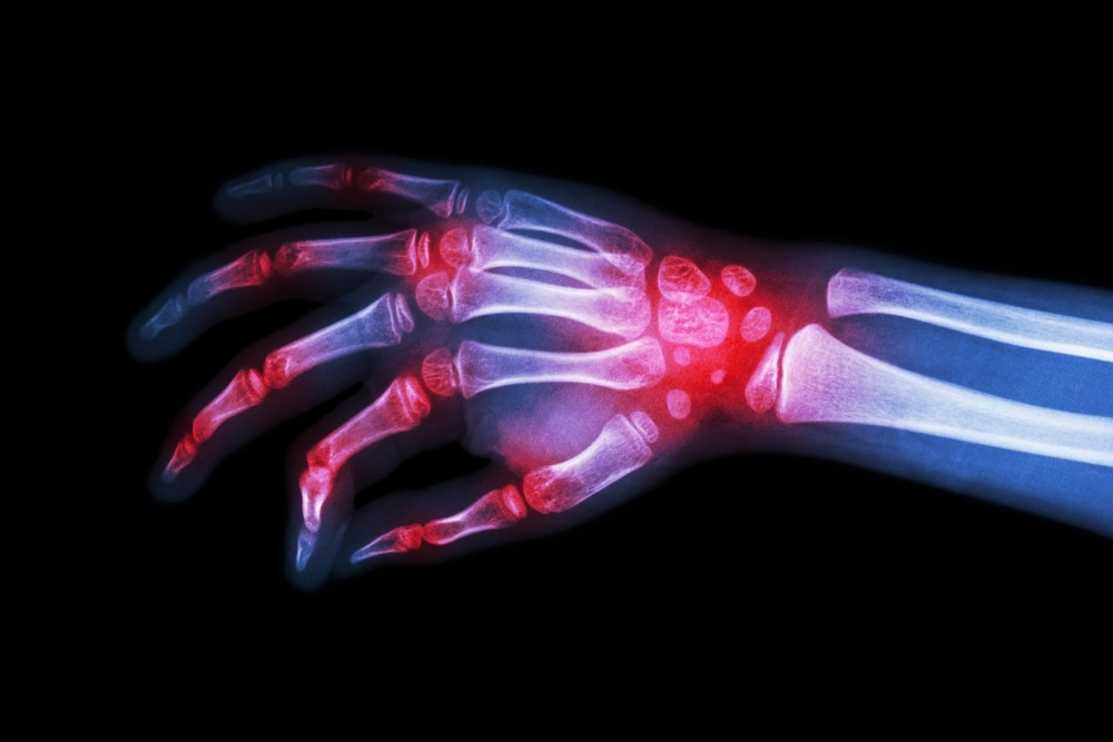 Rheumatoid arthritis linked to other diseases, finds new study