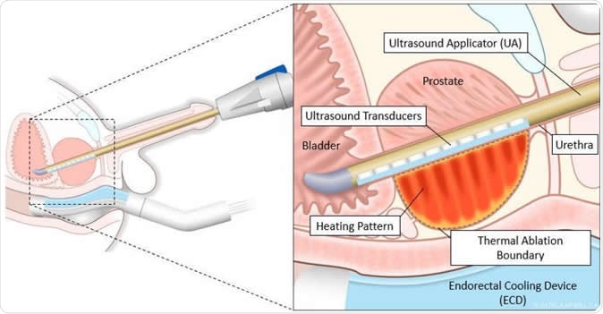 This diagram shows controlled and precise ablation using TULSA-PRO®.