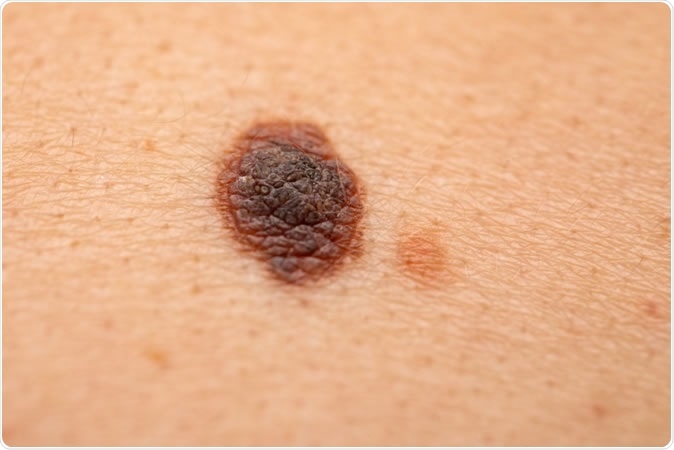 Study hints why some melanomas more likely to spread