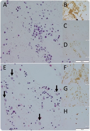 Cancer in the eye does not always develop into central nervous system lymphoma