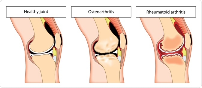 Osteoartritis comparado con la artritis reumatoide - comprensión de las diferencias