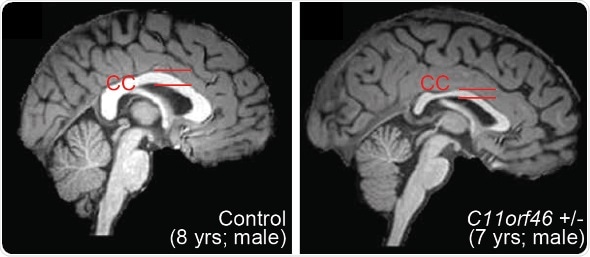 Precision epigenome editing can repair genetic syndrome of intellectual disability