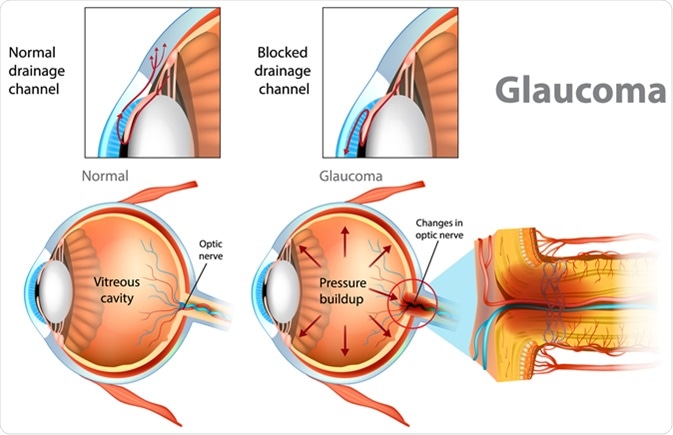 restaurarea vederii chirurgie glaucom