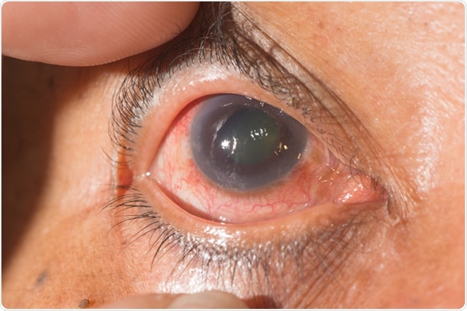 What is Traumatic Glaucoma?