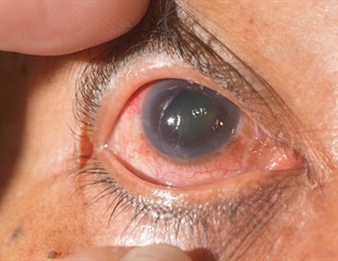 What is Traumatic Glaucoma?