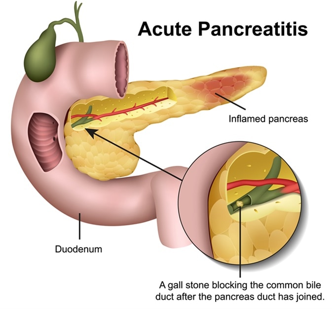 high protein diet in acute pancreatitis?