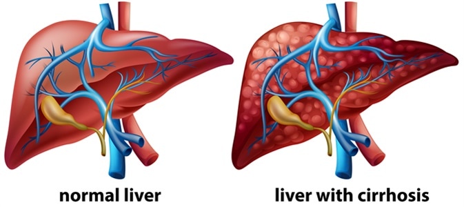 Image result for cirrhosis