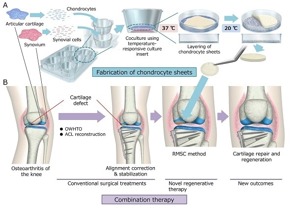 osteoarthritis treatment