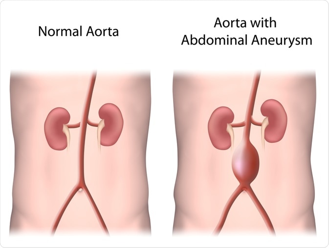 define aneurysm medical