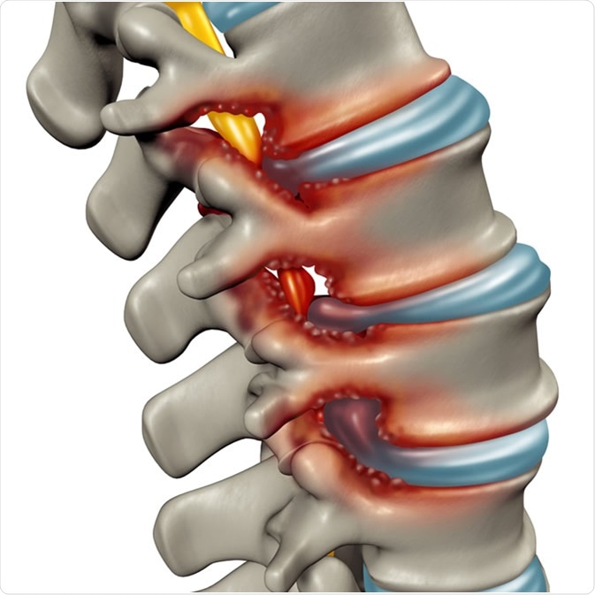 Resultado de imagen de Spinal Stenosis