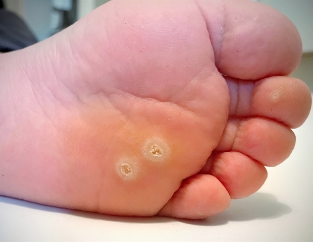 Verruca under foot. Wart on foot symptoms