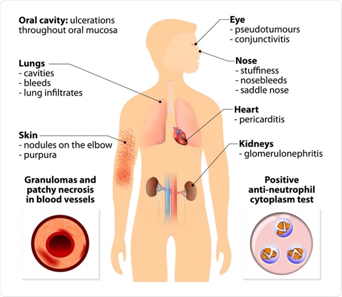 What Is Granulomatosis With Polyangiitis