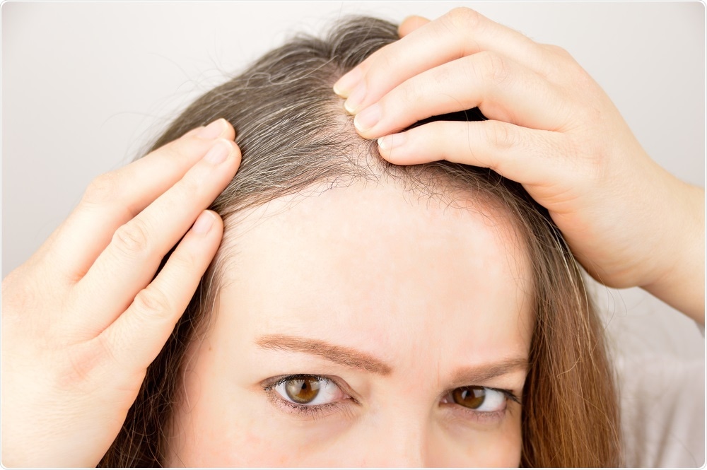 Hair loss could soon be a thing of the past, say researchers