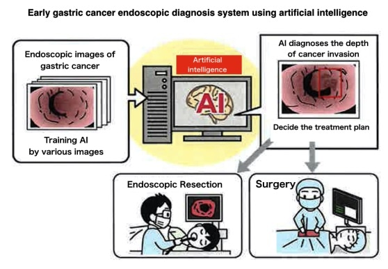 gastric cancer diagnosis