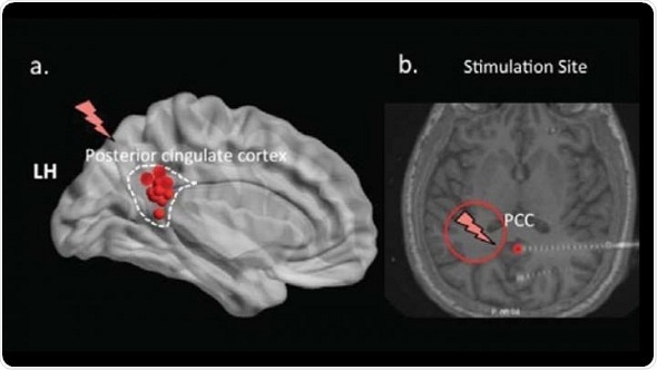 Deep brain stimulation impairs memory recall