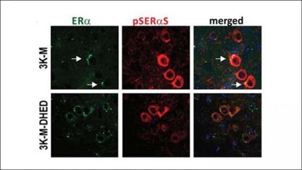 Estrogen could be viable treatment option for Parkinson