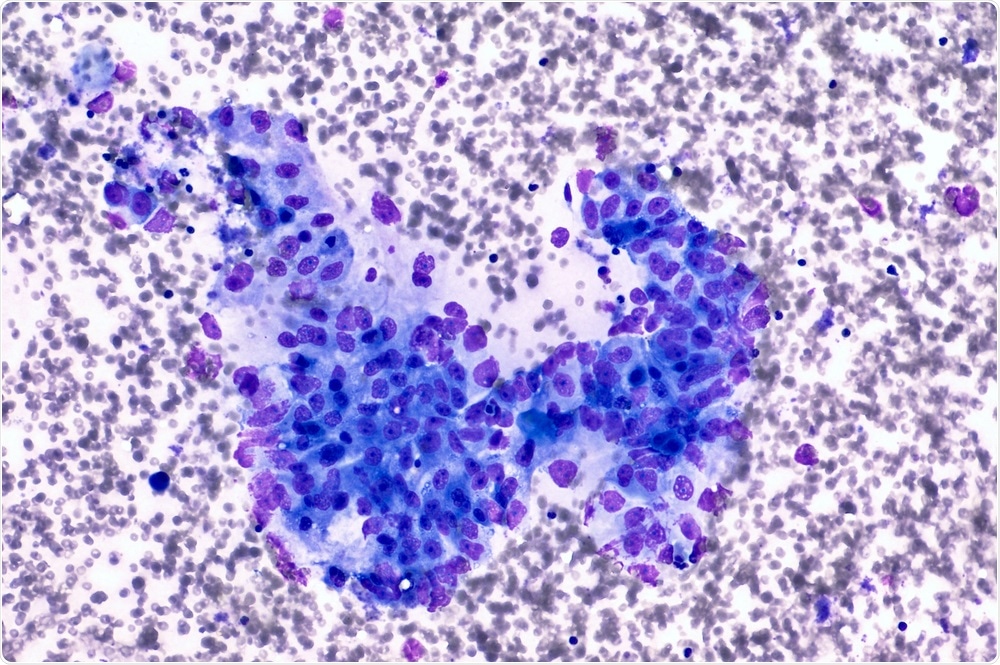 Pancreatic cancer cells - labeled after CT / biopsy aspirate