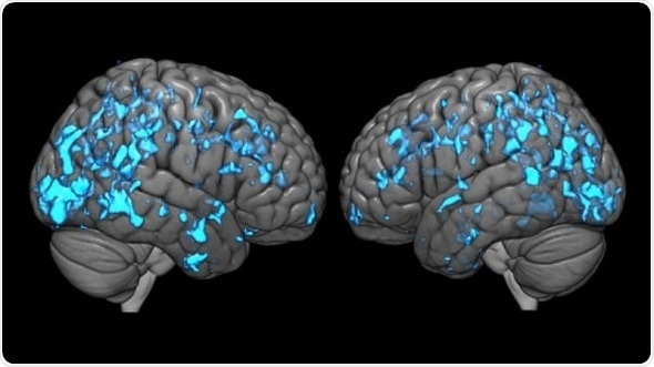 Johns Hopkins researchers reveal why deep brain stimulation improves Parkinson’s symptoms