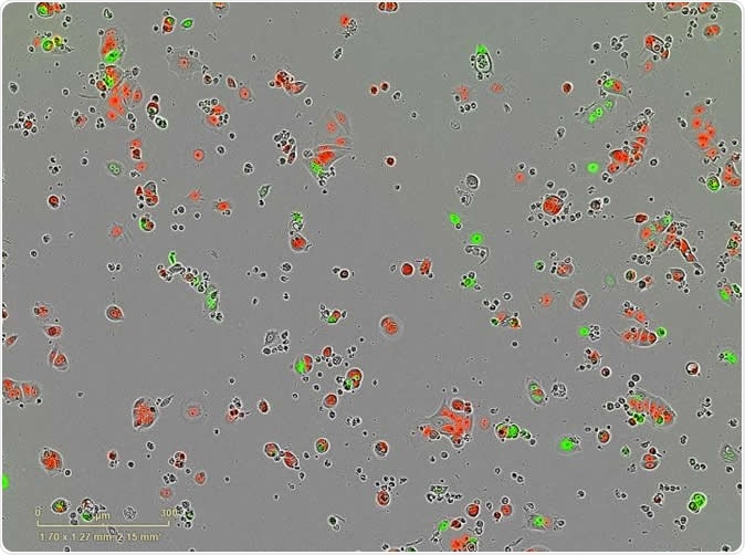 Breast cancer sleeper cells: Dormant