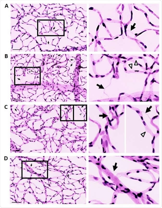 New study identifies potential enzyme target for diabetic retinopathy