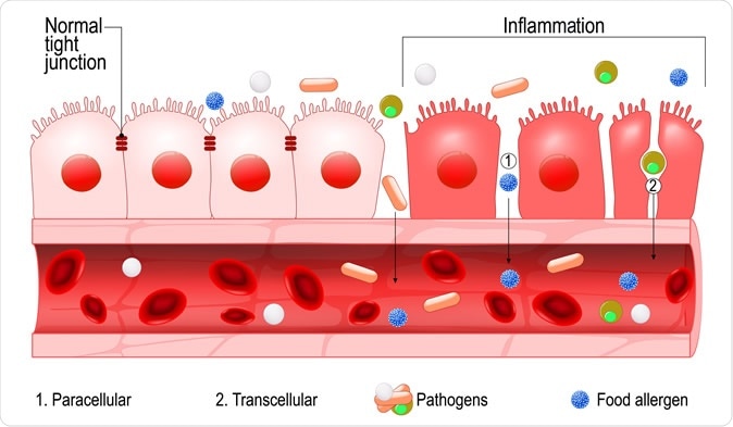 Leaky gut: All sodas including diet increase risk of premature death