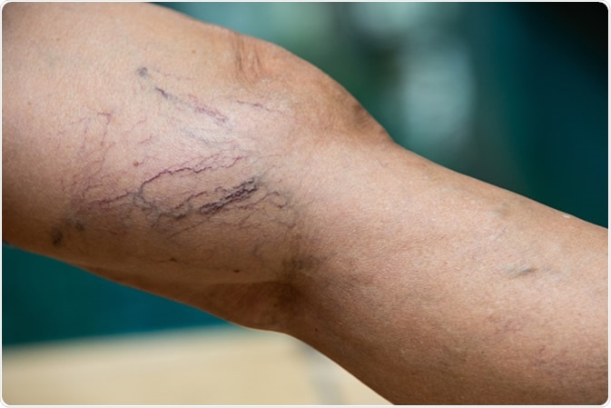 What are Varicose Veins and Can They be Treated?