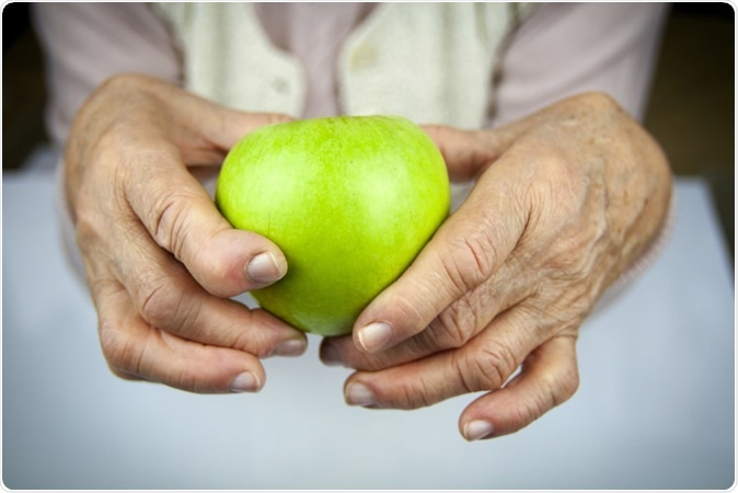 Rheumatoid arthritis in the hands