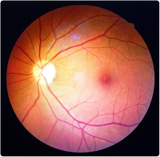 Diabetic retinopathy