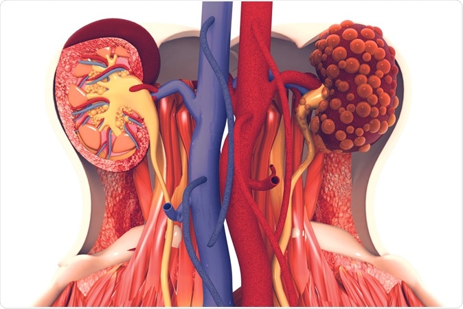Kidney disease. 3d illustration