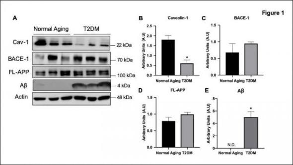 Researchers identify potential target for diabetes-associated Alzheimer's disease