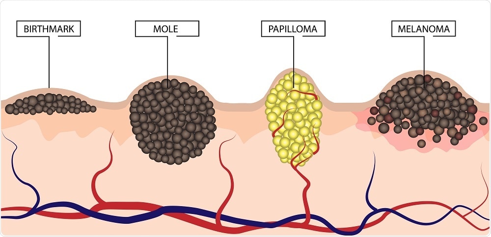 melanoma development - diagram