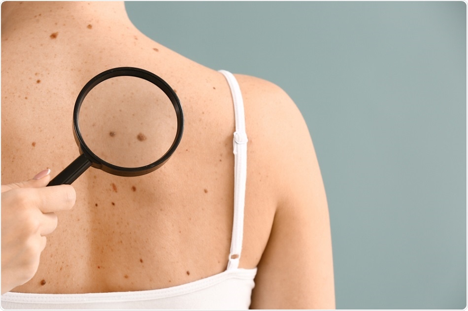 A new method to distinguish benign and cancerous skin moles