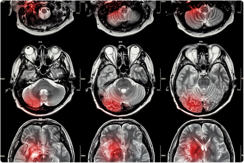 MRI shown to be a powerful tool in the detection and prevention of minor stroke