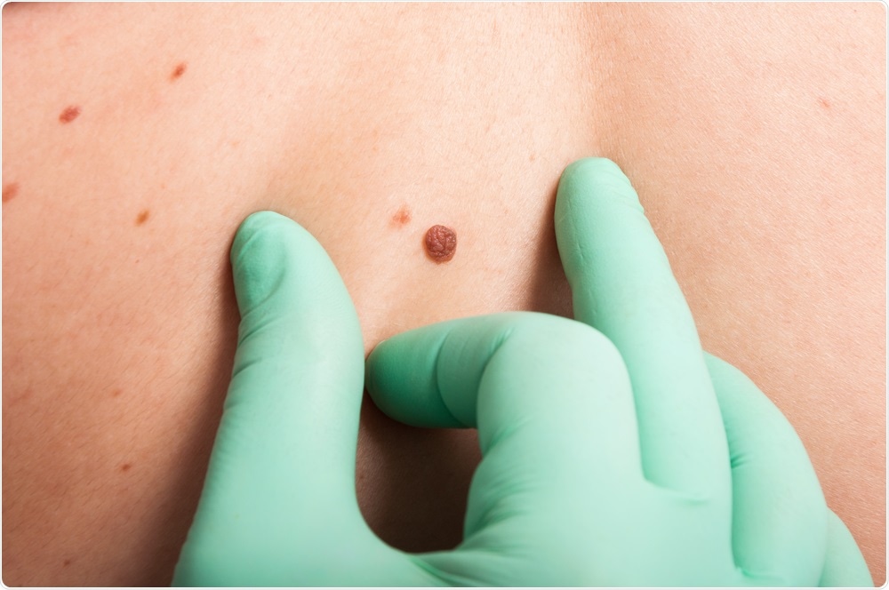 Pioneering melanoma test to be made available within two years