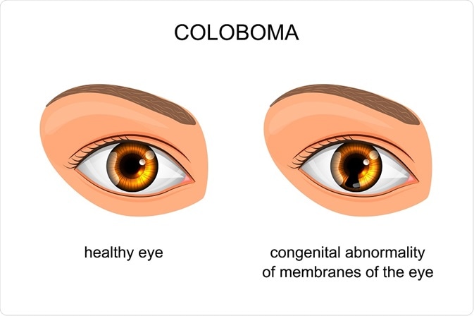 Normal eyes compared to person with Coloboma - By Artemida-psy